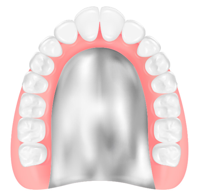 金属床義歯